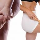 Die wahren Ursachen von Cellulite und wie Du sie für immer loswirst