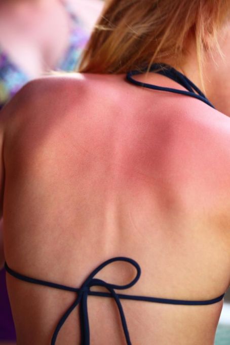 DAS hilft gegen SONNENBRAND