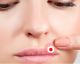 Lippenherpes: Vorbeugung und Hausmittel gegen die schmerzhaften Bläschen