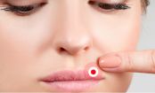 Lippenherpes: Vorbeugung und Hausmittel gegen die schmerzhaften Bläschen