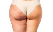 Macht Schluss mit den Dellen: Mit diesen Lebensmitteln werdet ihr endlich eure Cellulite los