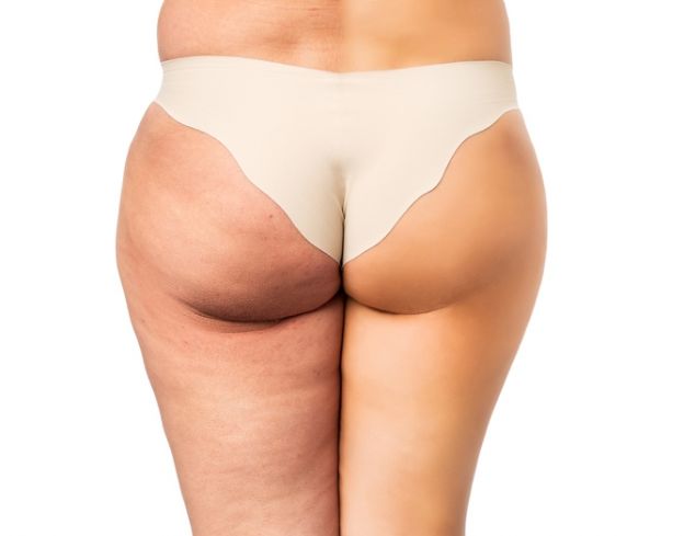 Weg mit der Cellulite