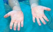 Warum werden die Finger schrumplig, wenn man lange im Wasser ist?