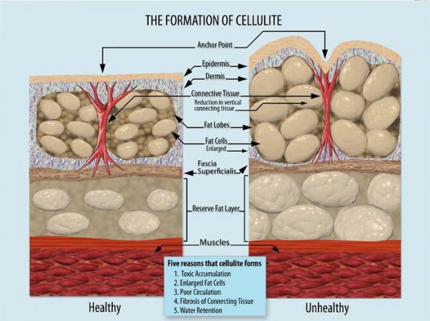 Was verursacht Cellulite?