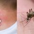 #2 zur linderung von insektenstichen
